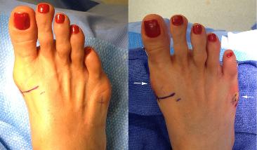 scarless bunion