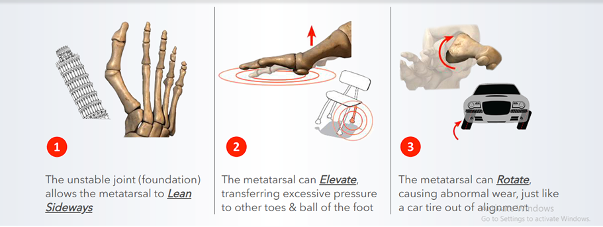 lapiplasty bunion